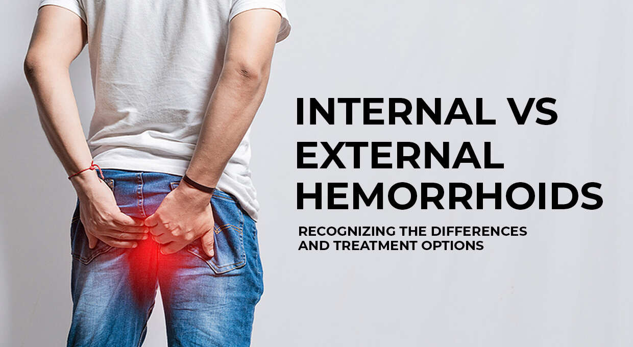 Internal vs External Hemorrhoids