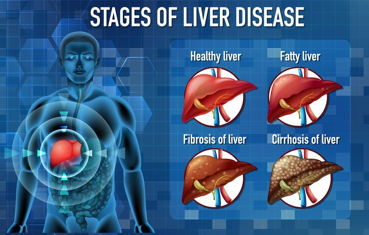 stages of liver disease
