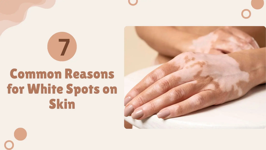 Safed Daag (White Spots on Skin): Causes and Ayurvedic Treatment